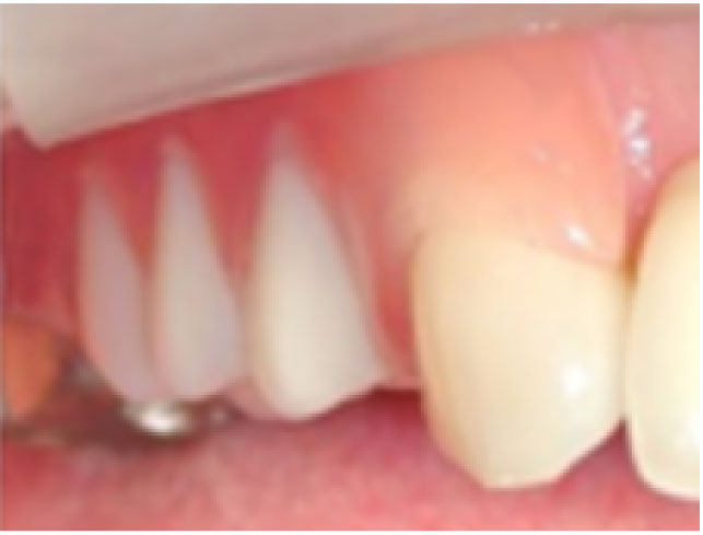 金属バネを使わない入れ歯